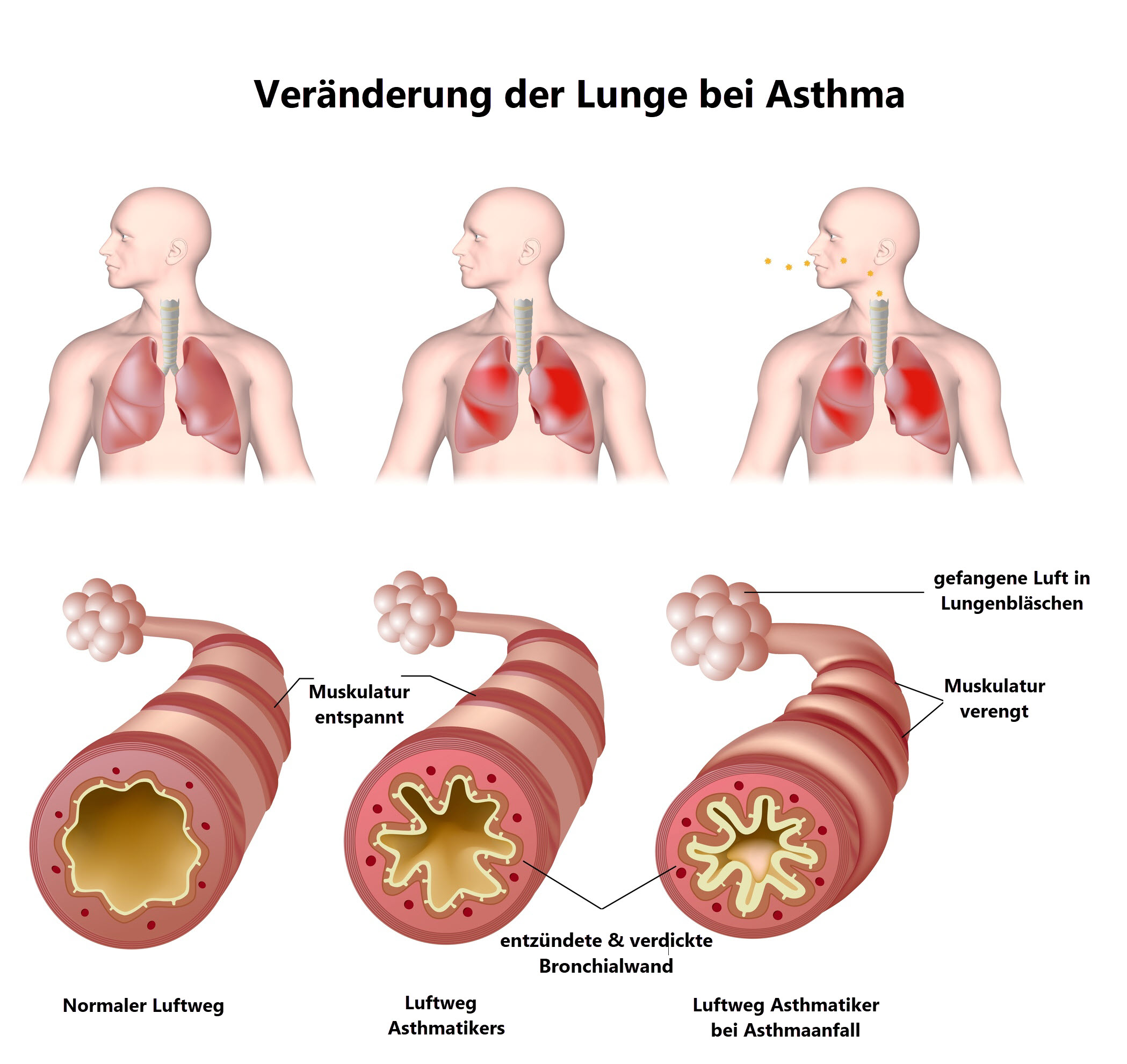 Asthma_Veränderung der Lunge