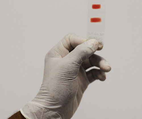 Sichelzellkrankheit | Novartis - klinische Forschung - Blutprobe
