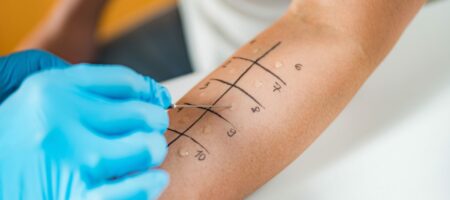 Lebensmittelallergien | Novartis - klinische Forschung - Closeup von Hautstich Allergietest