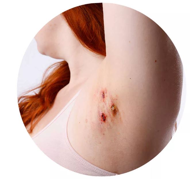 Bild Acne inversa