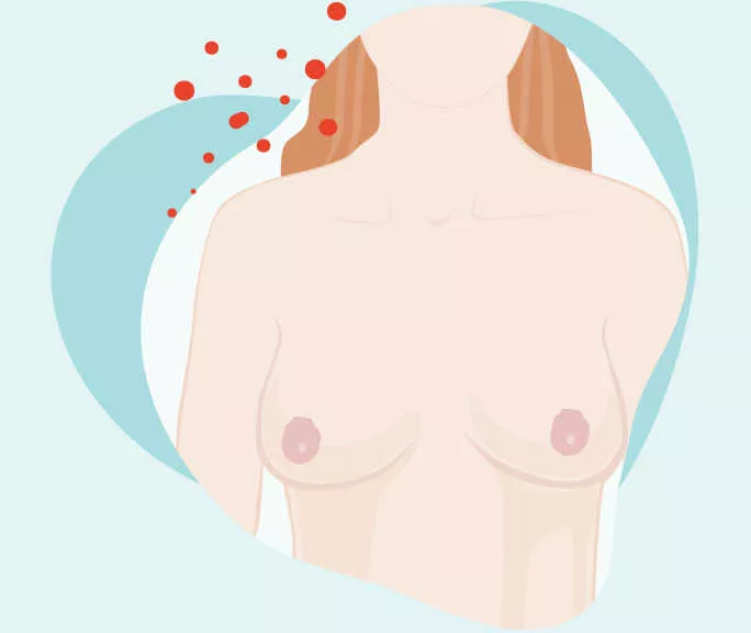 Brustkrebs Übersicht | Novartis klinische Forschung | Darstellung weibliche Brust