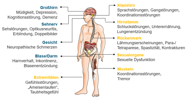 Infografik zu Multipler Sklerose mit betroffenen Organen und möglichen Symptomen.
