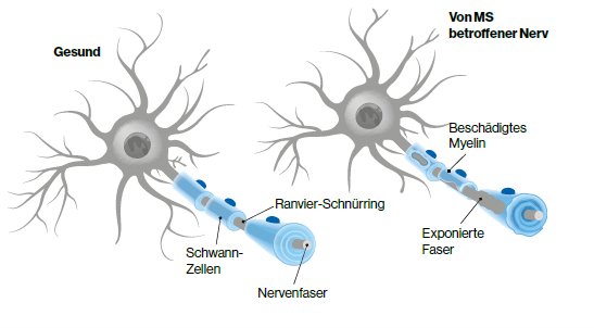 Infografik zum Vergleich eines gesunden Nervs und eines durch Multiple Sklerose geschädigten Nervs.